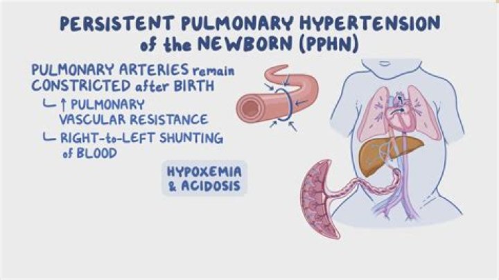 Understanding Dwarfism In Newborns: Causes And Treatment Options